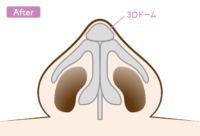 鼻尖形成：3DPCLドームAfter