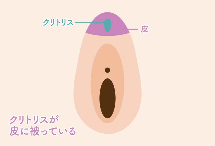 クリトリス　糸 聖心美容クリニック