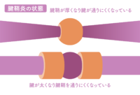 【腱鞘炎の状態】腱鞘が厚くなり腱が通りにくくなっている／腱が太くなり腱鞘を通りにくくなっている